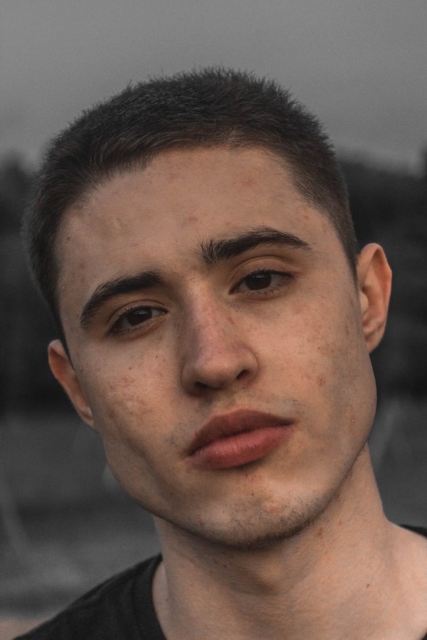 Est-ce que l'acné peut partir tout seul ?